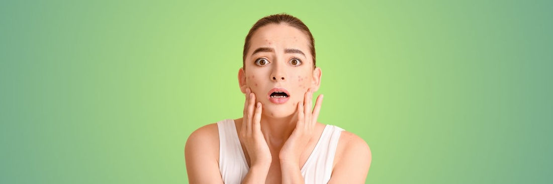 Conference Complexion: Navigating Period Acne During Multi-Day Events