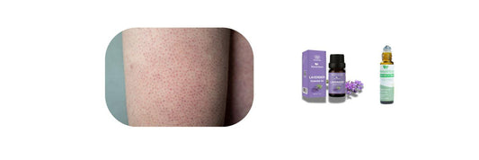 Soothe Keratosis Pilaris: A Guide to Lavender & Tea Tree Oils