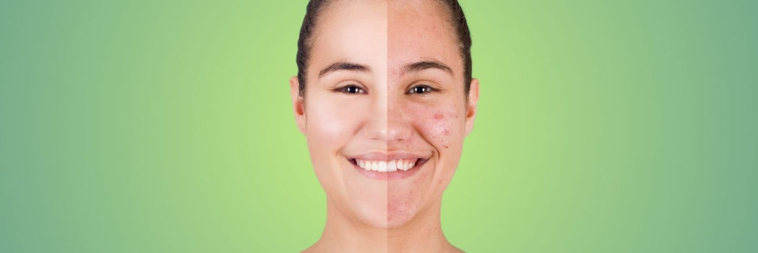 Decoding Period Acne: Expert Tips for Clearer Skin Before and During Your Cycle